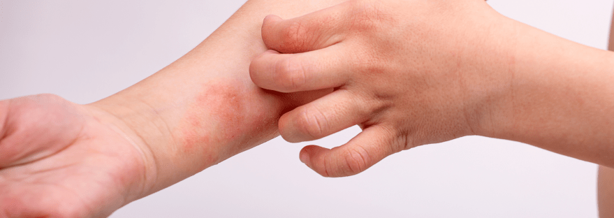 child with eczema on forearm